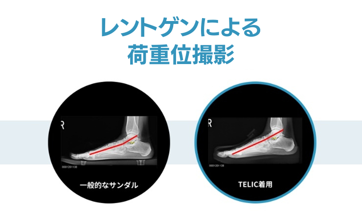 Doctor’s Sabotのレントゲンによる荷重位撮影